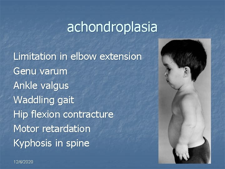 achondroplasia Limitation in elbow extension Genu varum Ankle valgus Waddling gait Hip flexion contracture