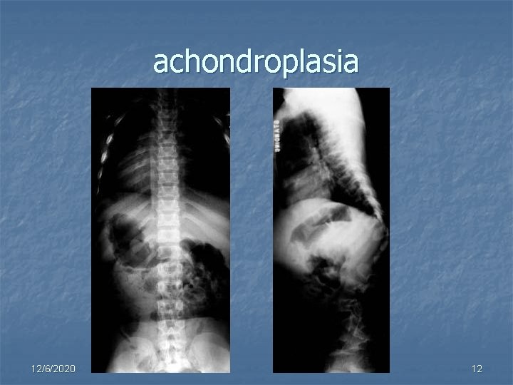 achondroplasia 12/6/2020 12 