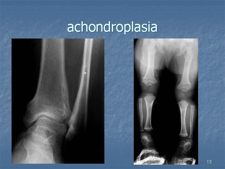 achondroplasia 12/6/2020 13 
