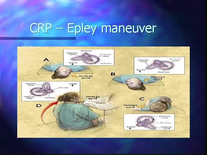 CRP – Epley maneuver 