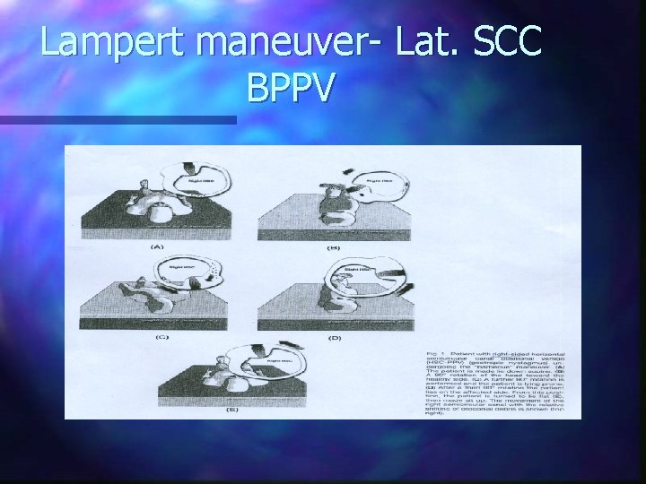 Lampert maneuver- Lat. SCC BPPV 