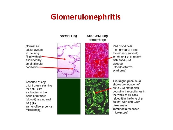 Glomerulonephritis 