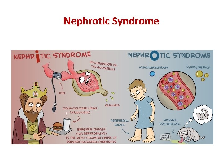 Nephrotic Syndrome 