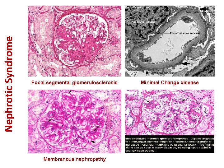 Nephrotic Syndrome Focal-segmental glomerulosclerosis Membranous nephropathy Minimal Change disease 