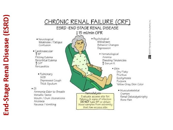 End-Stage Renal Disease (ESRD) 