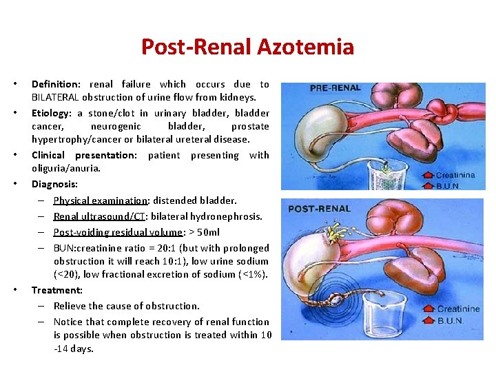 Post-Renal Azotemia • • • Definition: renal failure which occurs due to BILATERAL obstruction