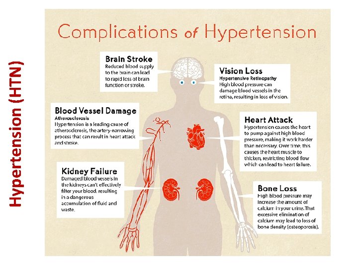 Hypertension (HTN) 