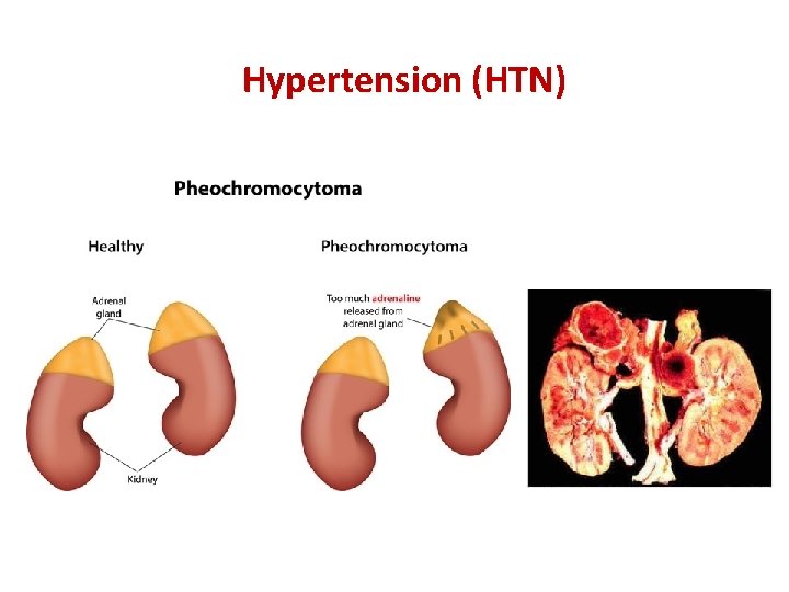 Hypertension (HTN) 