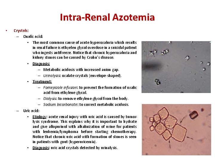 Intra-Renal Azotemia • Crystals: – Oxalic acid: • The most common cause of acute