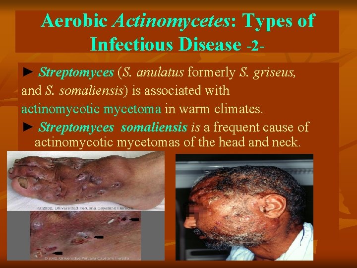 Aerobic Actinomycetes: Types of Infectious Disease -2► Streptomyces (S. anulatus formerly S. griseus, and