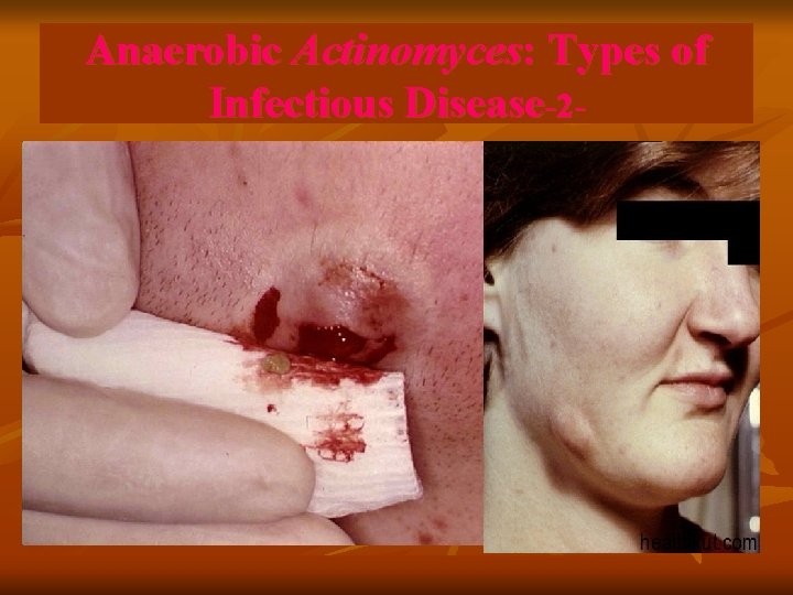 Anaerobic Actinomyces: Types of Infectious Disease-2 - 