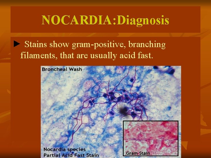 NOCARDIA: Diagnosis ► Stains show gram-positive, branching filaments, that are usually acid fast. 