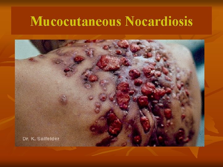 Mucocutaneous Nocardiosis 