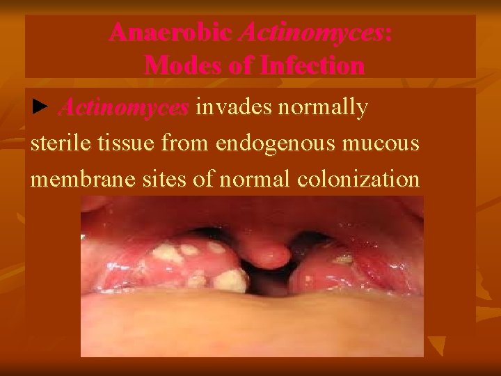 Anaerobic Actinomyces: Modes of Infection ► Actinomyces invades normally sterile tissue from endogenous mucous