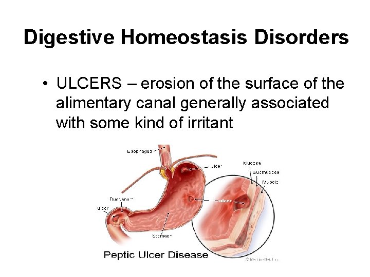 Digestive Homeostasis Disorders • ULCERS – erosion of the surface of the alimentary canal