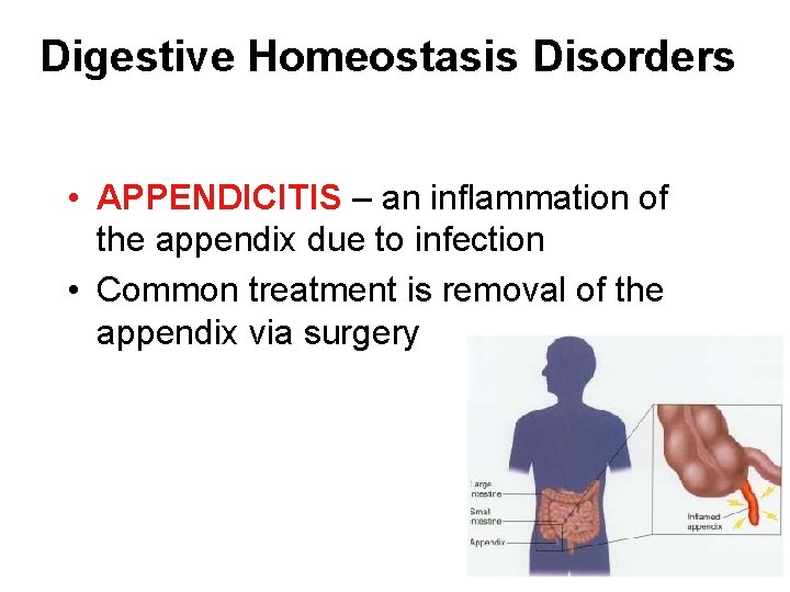 Digestive Homeostasis Disorders • APPENDICITIS – an inflammation of the appendix due to infection