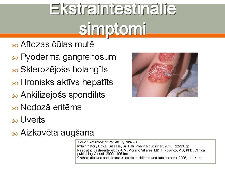 Ekstraintestinālie simptomi Aftozas čūlas mutē Pyoderma gangrenosum Sklerozējošs holangīts Hronisks aktīvs hepatīts Ankilizējošs spondilīts