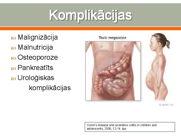 Komplikācijas Malignizācija Malnutricija Osteoporoze Pankreatīts Uroloģiskas komplikācijas Crohn’s disease and ulcerative colitis in children