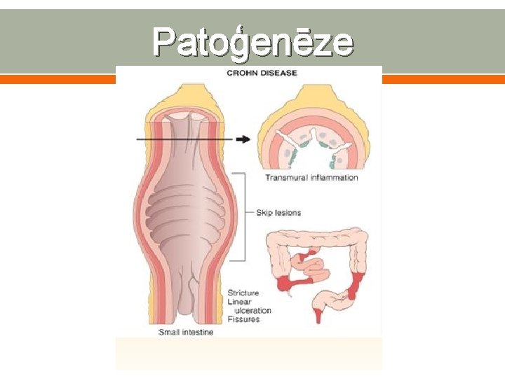 Patoģenēze 