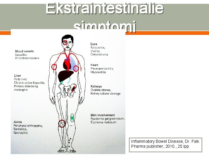 Ekstraintestinālie simptomi Inflammatory Bowel Disease, Dr. Falk Pharma publisher, 2010. , 25. lpp 