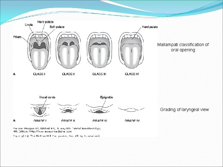 Mallampati classification of oral opening Grading of laryngeal view 