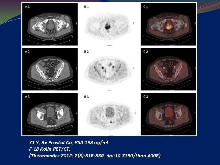 71 Y, Bx Prostat Ca, PSA 193 ng/ml F-18 Kolin PET/CT, (Theranostics 2012; 2(3):