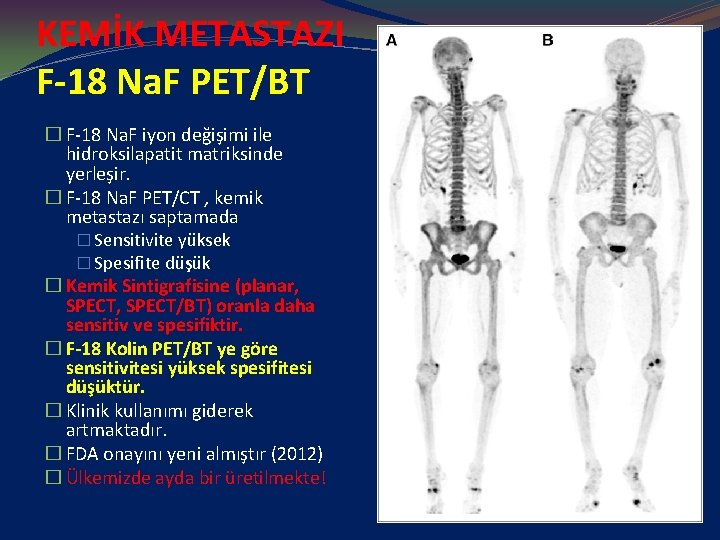 KEMİK METASTAZI F-18 Na. F PET/BT � F-18 Na. F iyon değişimi ile hidroksilapatit