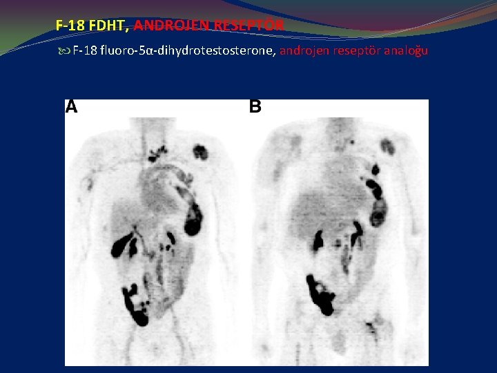 F-18 FDHT, ANDROJEN RESEPTÖR F-18 fluoro-5α-dihydrotestosterone, androjen reseptör analoğu 