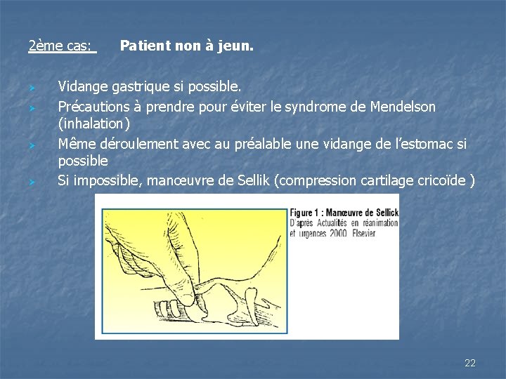 2ème cas: Patient non à jeun. Ø Vidange gastrique si possible. Ø Précautions à