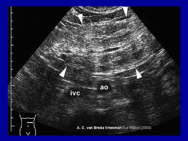 A. C. van Breda Vriesman Eur Radiol (2004) 