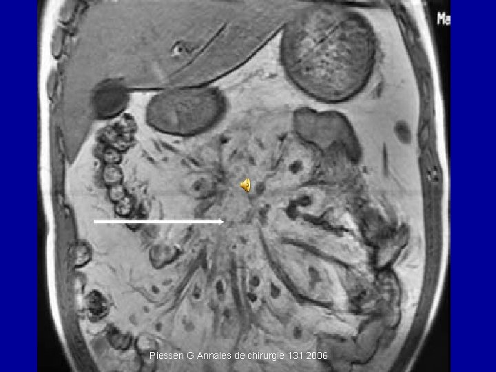 Piessen G Annales de chirurgie 131 2006 