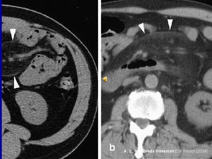 A. C. van Breda Vriesman Eur Radiol (2004) 