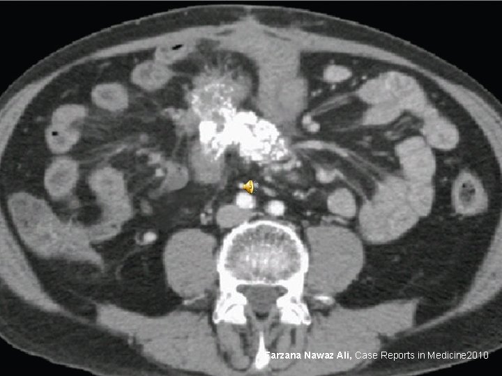 Farzana Nawaz Ali, Case Reports in Medicine 2010 