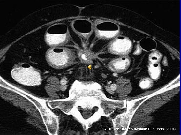 A. C. van Breda Vriesman Eur Radiol (2004) 