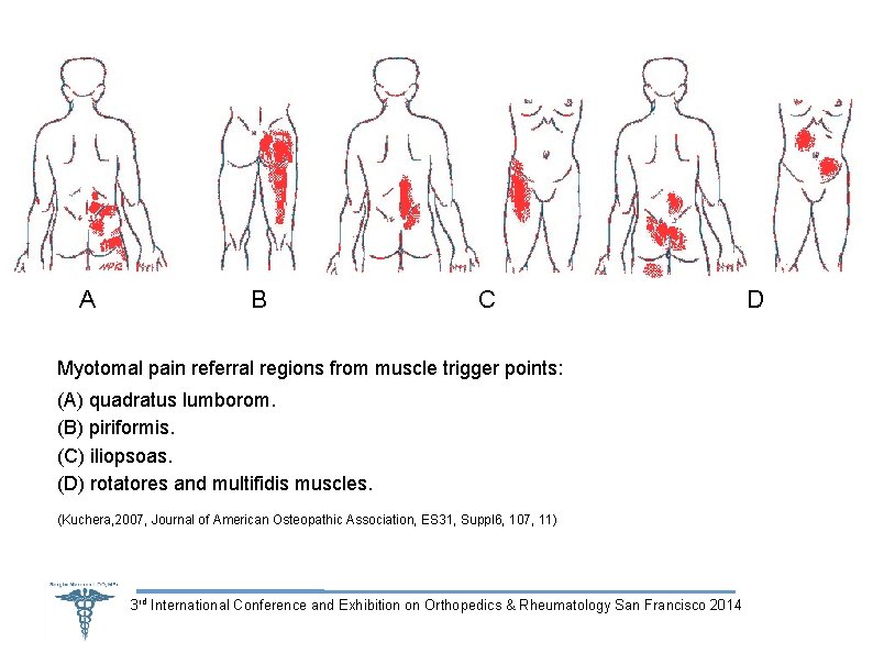 A B C Myotomal pain referral regions from muscle trigger points: (A) quadratus lumborom.
