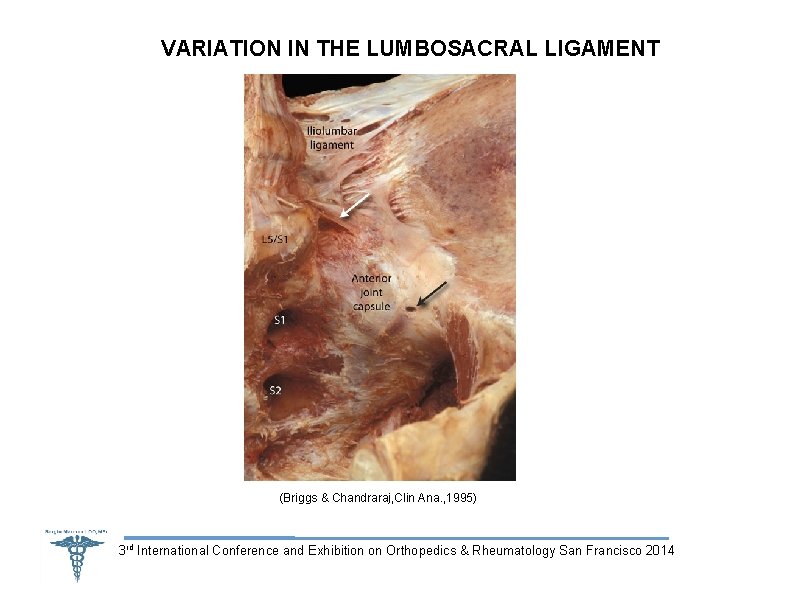 VARIATION IN THE LUMBOSACRAL LIGAMENT (Briggs & Chandraraj, Clin Ana. , 1995) 3 rd