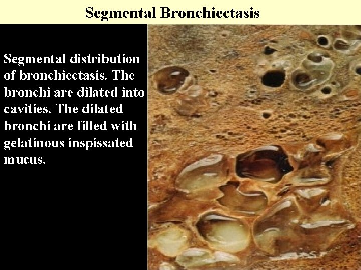 Segmental Bronchiectasis Segmental distribution of bronchiectasis. The bronchi are dilated into cavities. The dilated