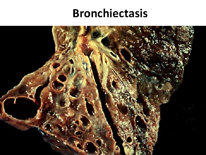 Bronchiectasis 