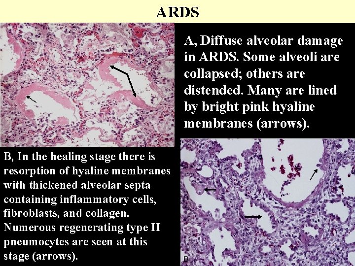 ARDS A, Diffuse alveolar damage in ARDS. Some alveoli are collapsed; others are distended.
