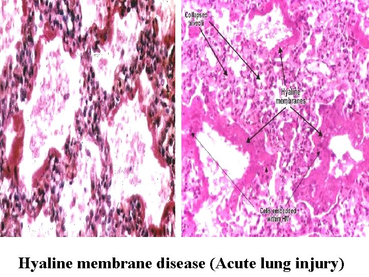 Hyaline membrane disease (Acute lung injury) 