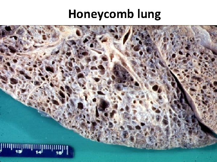 Honeycomb lung 