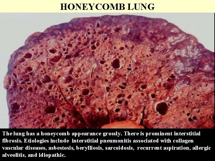 HONEYCOMB LUNG The lung has a honeycomb appearance grossly. There is prominent interstitial fibrosis.