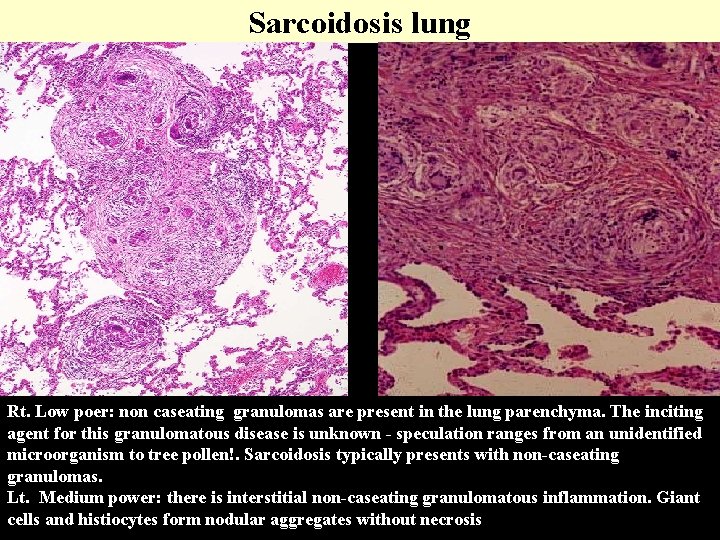 Sarcoidosis lung Rt. Low poer: non caseating granulomas are present in the lung parenchyma.
