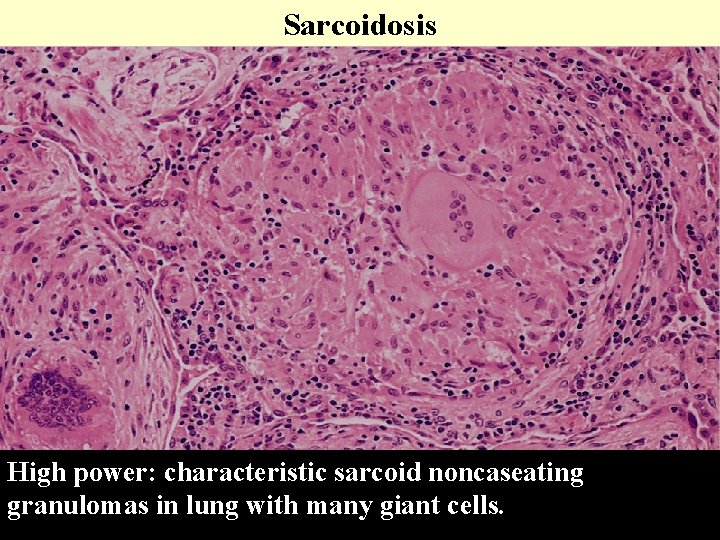 Sarcoidosis High power: characteristic sarcoid noncaseating granulomas in lung with many giant cells. 