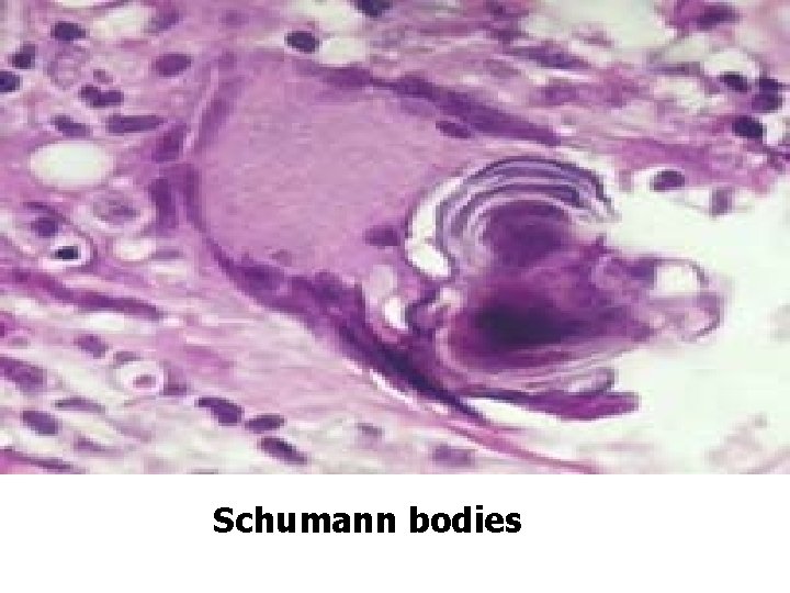 Bronchiectasis DR AYSER HAMEED LEC 4 Bronchiectasis Is