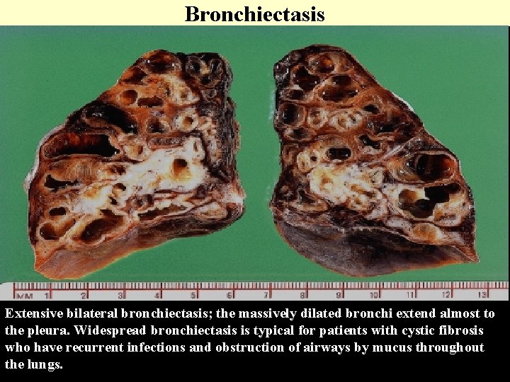 Bronchiectasis Extensive bilateral bronchiectasis; the massively dilated bronchi extend almost to the pleura. Widespread