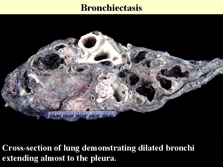 Bronchiectasis Cross-section of lung demonstrating dilated bronchi extending almost to the pleura. 