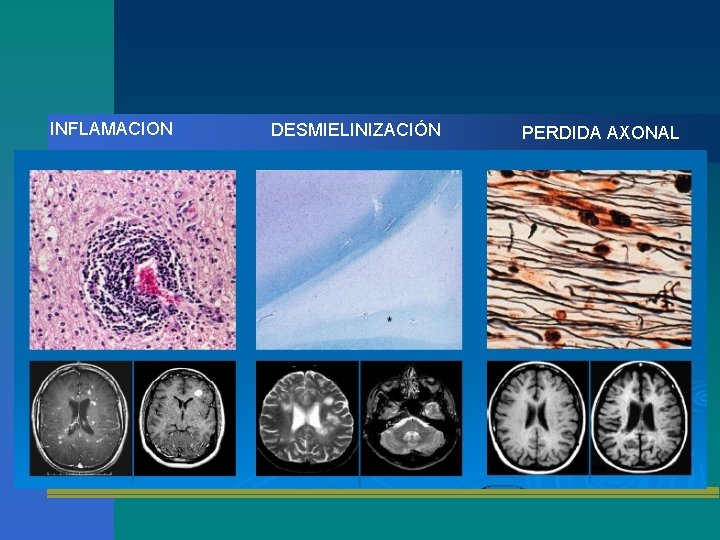 INFLAMACION DESMIELINIZACIÓN PERDIDA AXONAL 