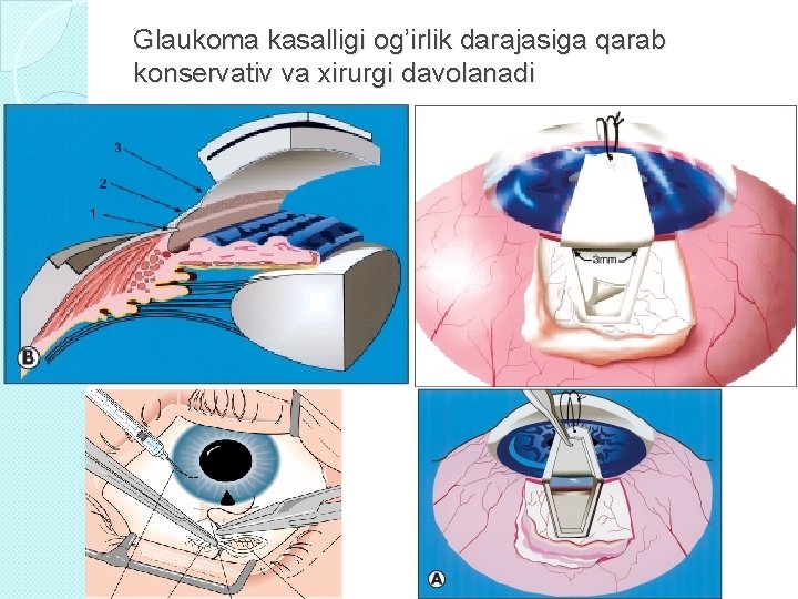 Glaukoma kasalligi og’irlik darajasiga qarab konservativ va xirurgi davolanadi 