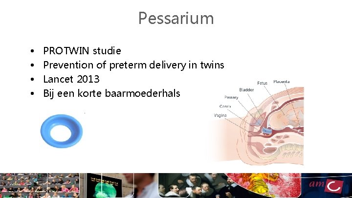 Pessarium • • PROTWIN studie Prevention of preterm delivery in twins Lancet 2013 Bij